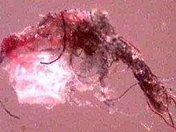 Click to enlarge Morgellons lesion fibers