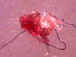 Click to enlarge Morgellons lesion fibers