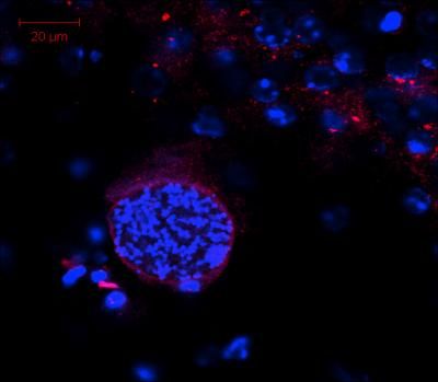 Click to enlarge toxoplasmosis cyst