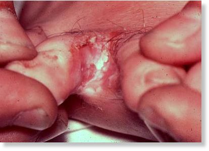 Aids Fungus