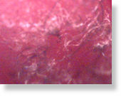 Fibers removed from lesions on the skin of Morgellon’s Disease sufferers