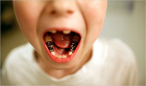 Click to enlarge cavities from pollutants