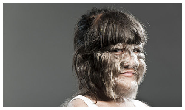called quot;werewolf syndromequot; werewolf syndrome. called quot;werewolf syndromequot;