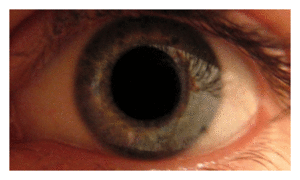 Click to enlarge Dilated Eyes