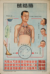 tuberculosis poster