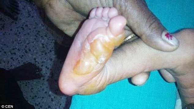 Click to enlarge baby spontaneously combusted feet photo