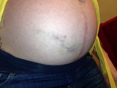 beaten pregnant woman's belly