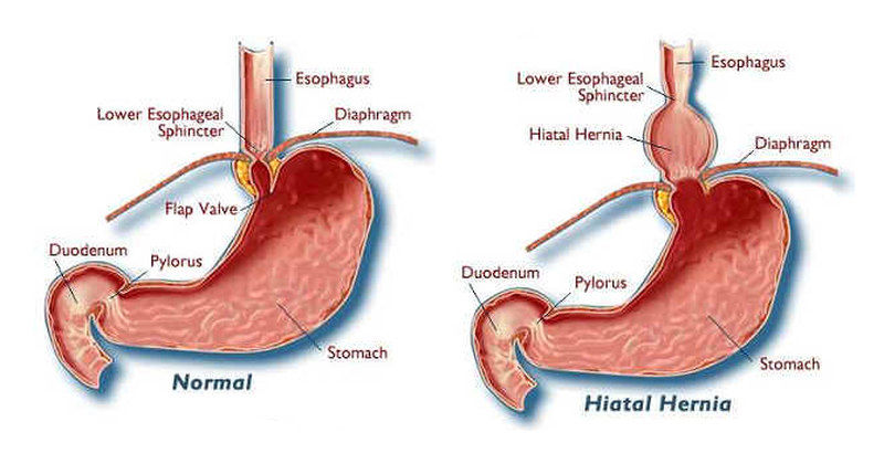 What are ways to alleviate esophagus spasms caused by a hiatal hernia?
