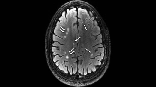 An MRI scan of a 28-year-old man with blast-related mild TBI shows a total of 76 lesions on all sections of his brain