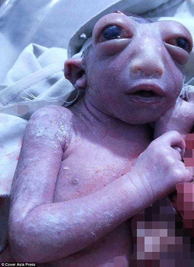 A baby girl has been born in India without a head