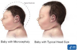 comparison normal baby and microencephaly