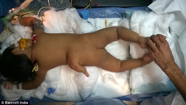 Varsha Sena, two, was born with an extra leg 
