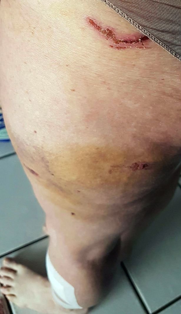 Bites and bruises on Kerry's body caused by the wombat attack 