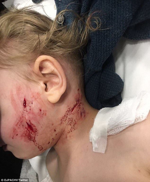 A photo taken after the attack shows the left side of the little boy's face with several bite wounds. 