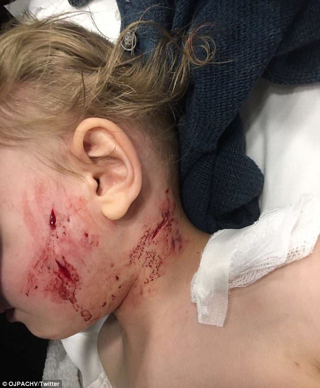 Click to enlarge A photo taken after the attack shows the left side of the little boy's face with several bite wounds.