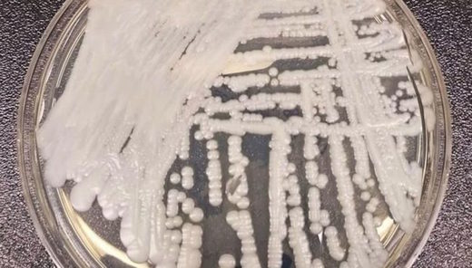 Candida auris: The 'superbug' fungus is spreading across the US