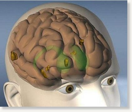Parkinson's brain