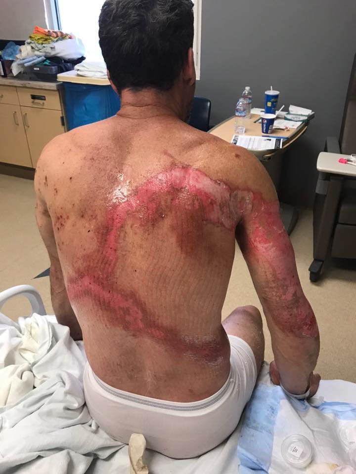 Chris suffered second-degree burns on his back and arm