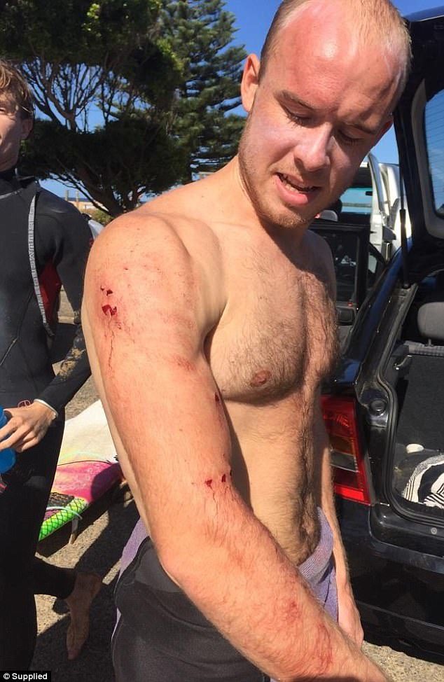 Charlie Fry (pictured), 25, was bitten by a shark on Monday as he surfed at Avoca Beach