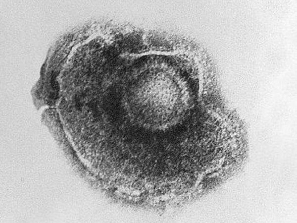 Electron micrograph of a varicella zoster virus