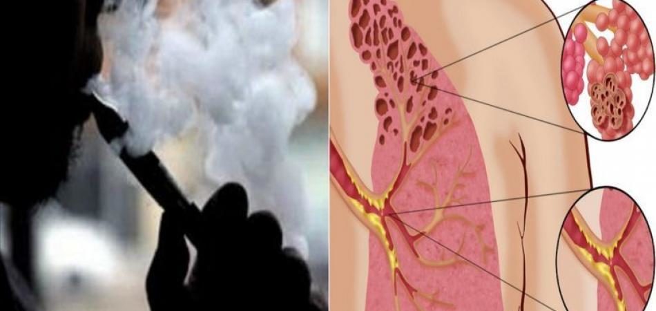 vaping lung disease