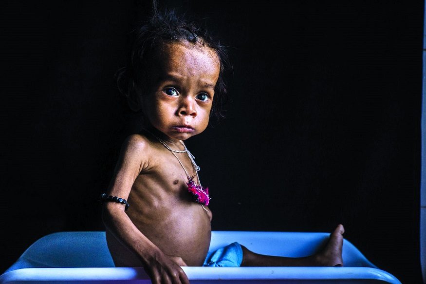 unicef report children undernourished