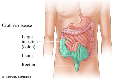 Crohns disease