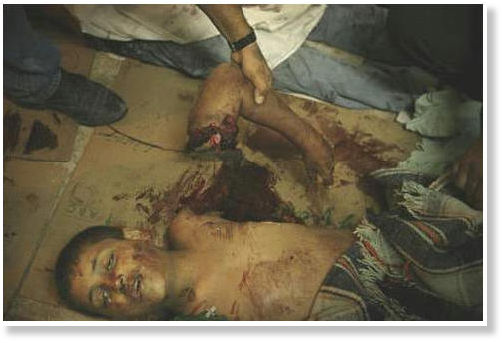 palestine boy, arm cut off