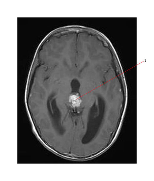Click to enlarge Pineal Gland