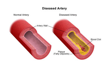 Click to enlarge Diseased Artery
