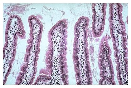 Click to enlarge Celiac Disease