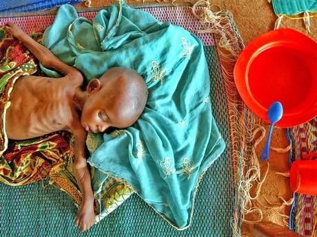 malnourished infant in Maradi
