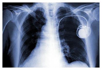 Click to enlarge Pacemaker