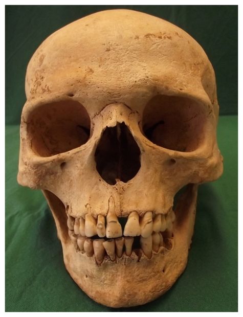 Skull with Leprosy