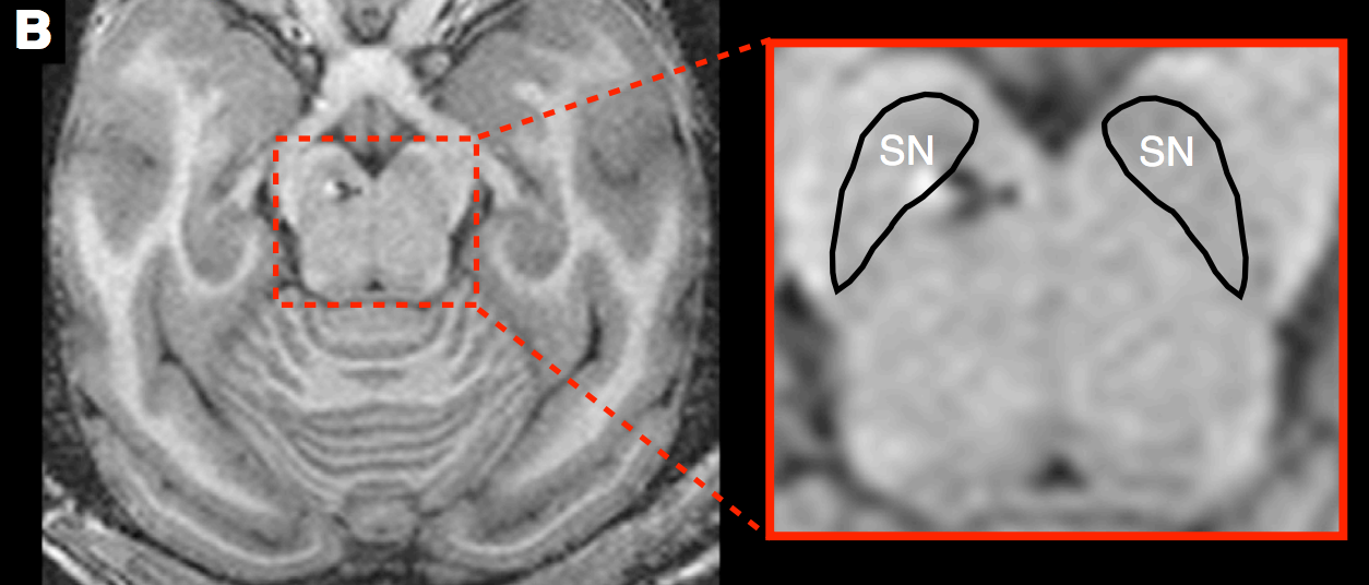 Click to enlarge Brain Implant