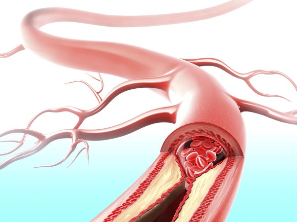 atherosclerotic plaques inside blood vessels
