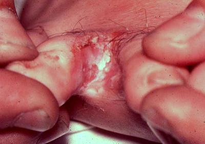 Candida 3
