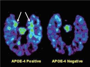 PET brain scans reveal plaque and tangle 