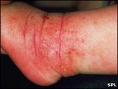eczema