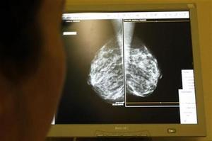 mammogram