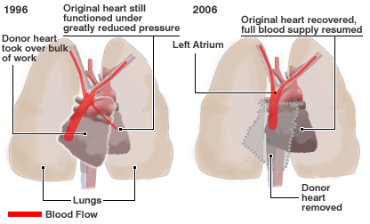 Click to enlarge piggyback heart transplant