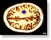 Radiotherapy