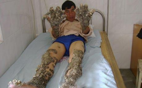 Coral growth on man