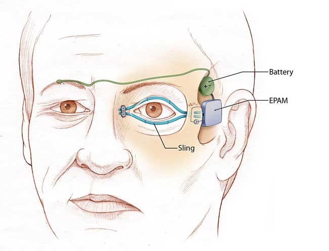 Click to enlarge artificial muscle for blinking