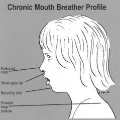Mouth Breathing