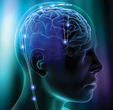 Brain Implants