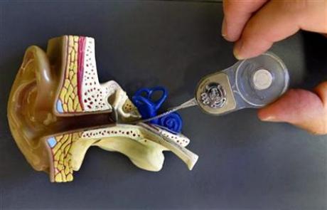 Cochlear Implant