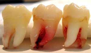 Click to enlarge Wisdom Tooth