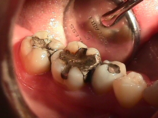 dental amalgam
