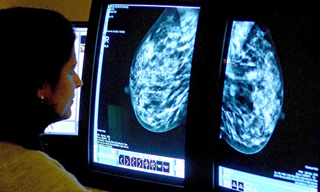 Mastectomy